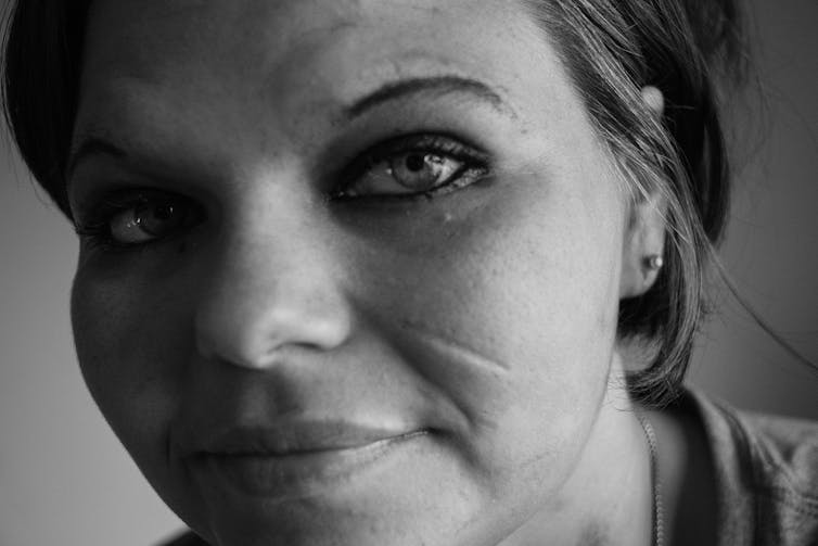 Close up black and white photo of a young woman with a black eye.