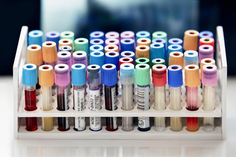 Array of blood test tubes in a rack