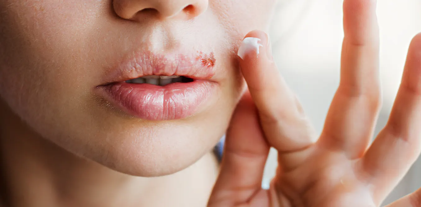 Cold Smearing Crusty, blistering and peeling: where do cold sores come from and what ...