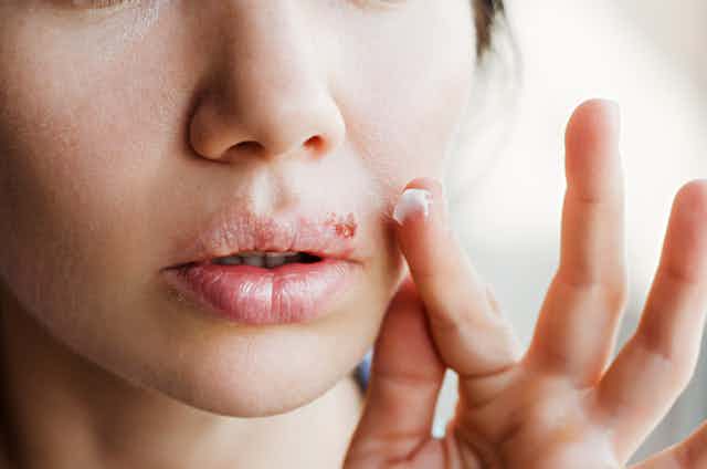 Woman holding cream up to mouth sore 