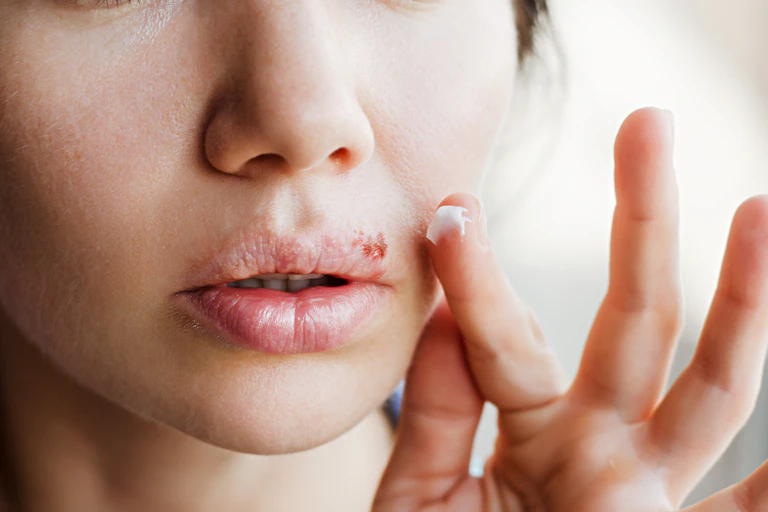 Woman holding cream up to mouth sore