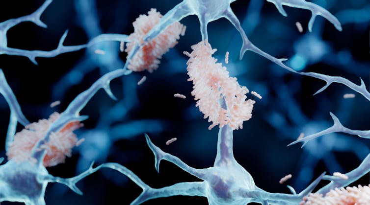 Placche di beta-amiloide (rosa) che si agglutinano sui neuroni (cellule cerebrali).