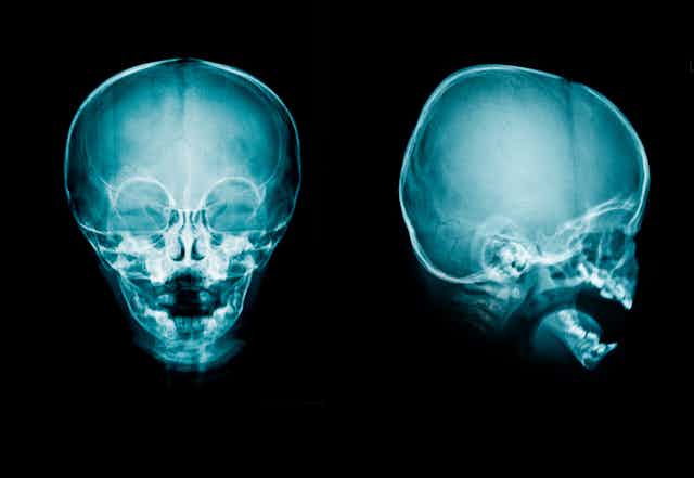 Un cráneo de rayos X muestra un tamaño anormal
