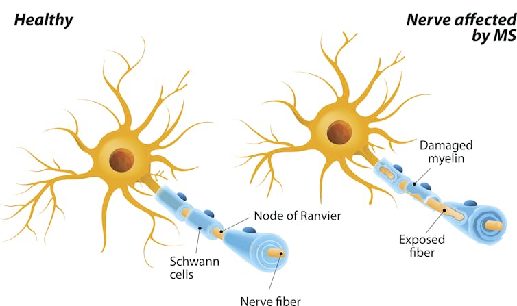 Diagram comparing healthy nerve and nerve affected by multiple sclerosis