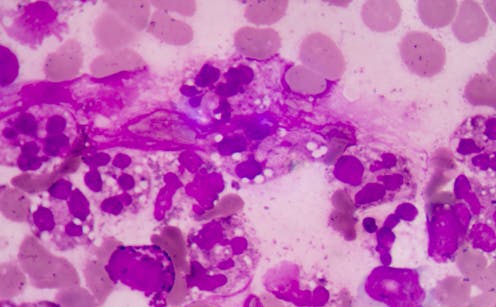 Genomics has helped identify a new strep A strain in Australia – and what has made it dangerous