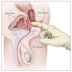 A man having his prostate gland examined.