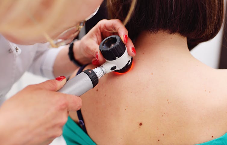 Doctor checks patient's mole