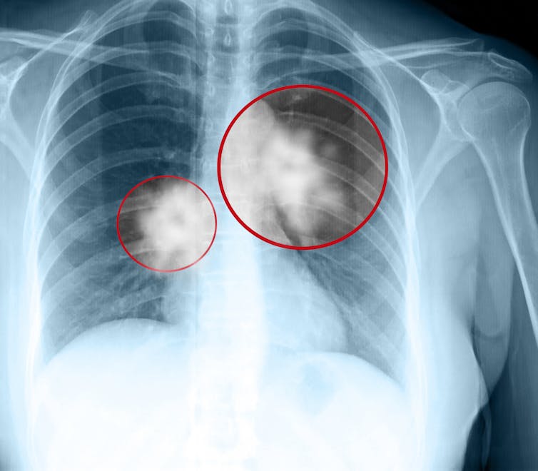 Highlighted spots on a chest x-ray