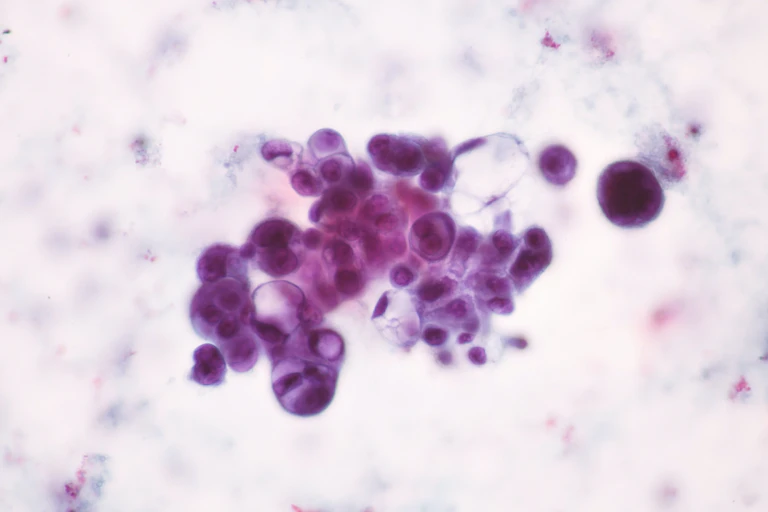 Células cancerosas.