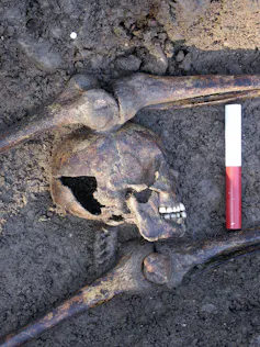A skull being dug out of the earth with a hole in the side showing evidence of blunt force trauma.