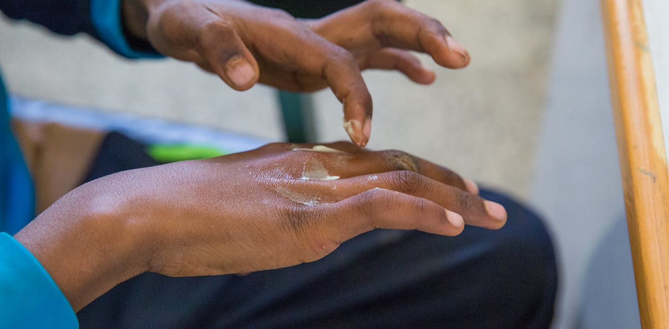 Leprosy, scabies and yaws – Togo’s neglected tropical skin diseases needattention
