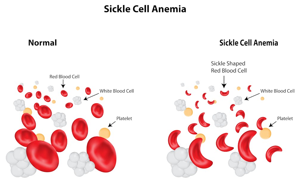 explainer one day science may cure sickle cell anaemia