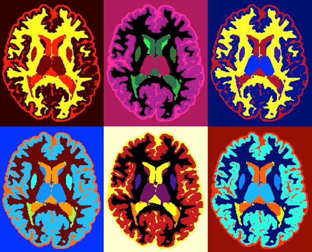 Images obtenues par IRM du cerveau d'une personne atteinte de sclérose en plaques.