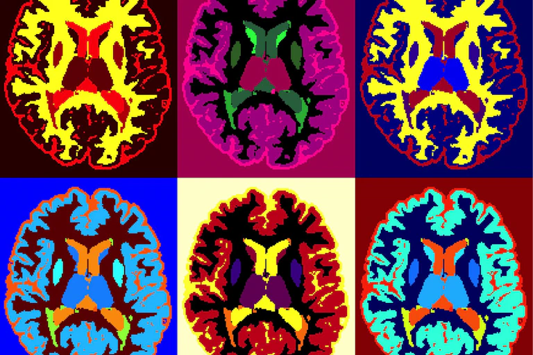 Images obtenues par IRM du cerveau d'une personne atteinte de sclérose en plaques.