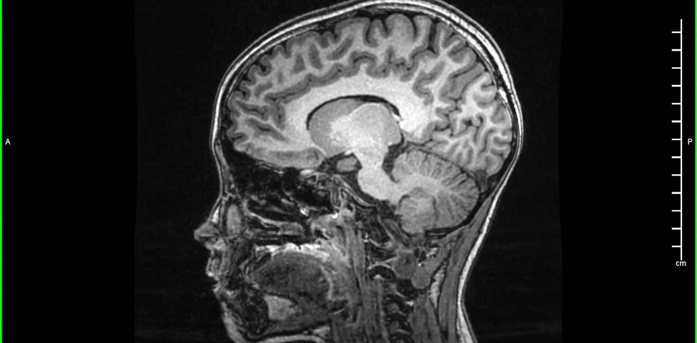 Santé mentale et soins psychiques de l’enfant : les impasses du « tout biologique » Santé mentale et soins psychiques de l’enfant : les impasses du « tout biologique »