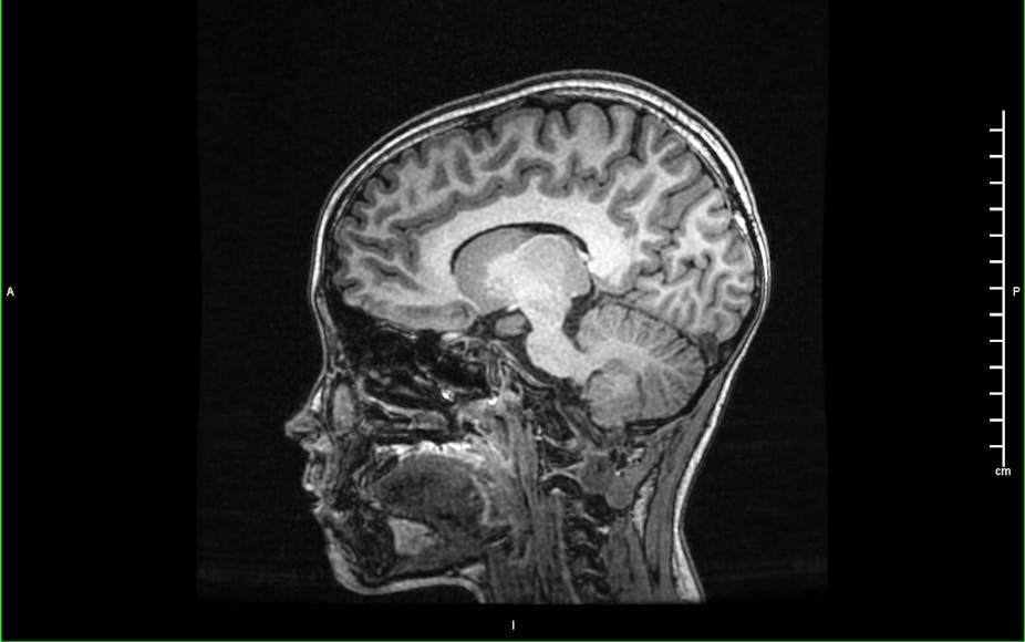 Vue d'un crâne d'enfant par IRMf