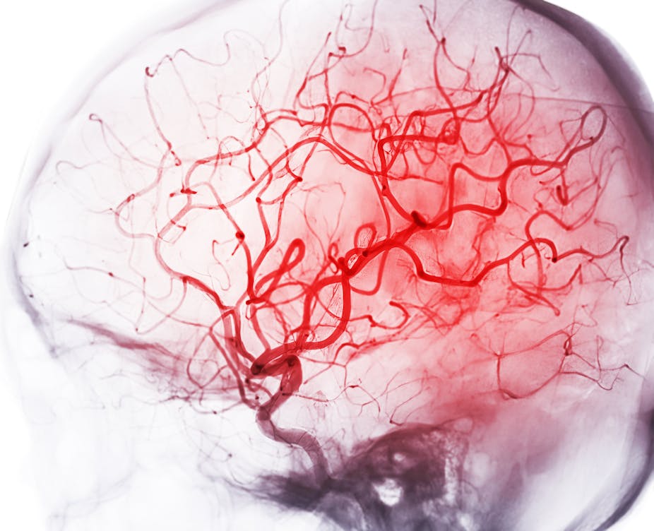 Angiography image of cerebral artery