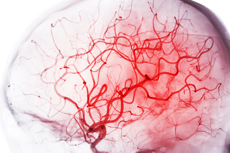 Angiography image of cerebral artery