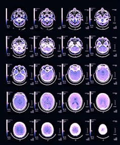 MRI brain scan images