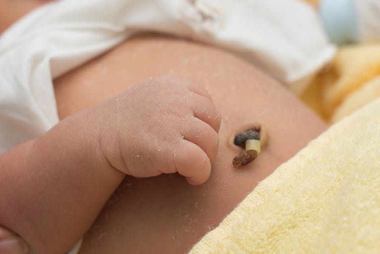 closeup of umbilical cord stump on infant