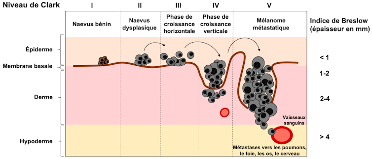 Classification de Clark et indice de Breslow du mélanome primaire