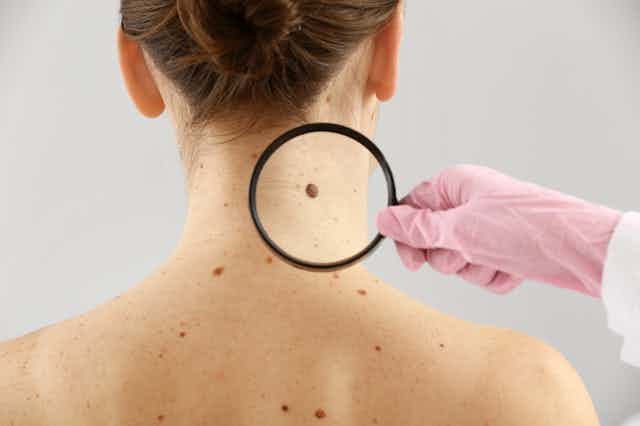 Une jeune femme fait examiner son cou et son dos, couverts de grains de beauté, à un dermatologue.
