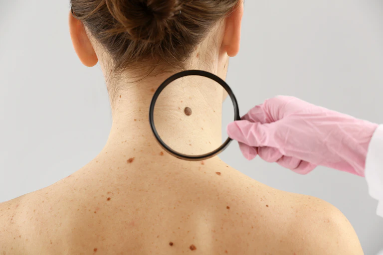 Une jeune femme fait examiner son cou et son dos, couverts de grains de beauté, à un dermatologue.