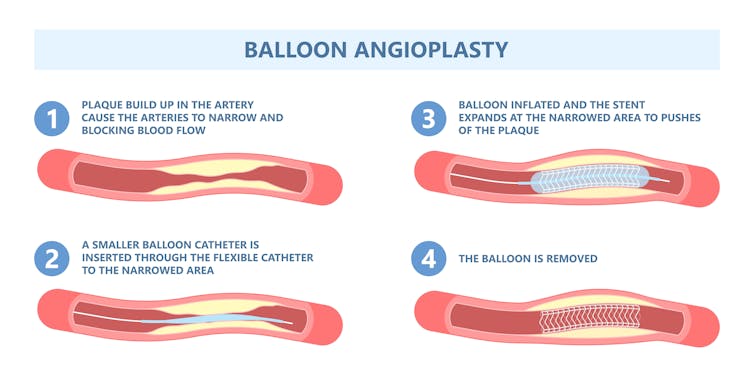 Drawings showing how angioplasty works.