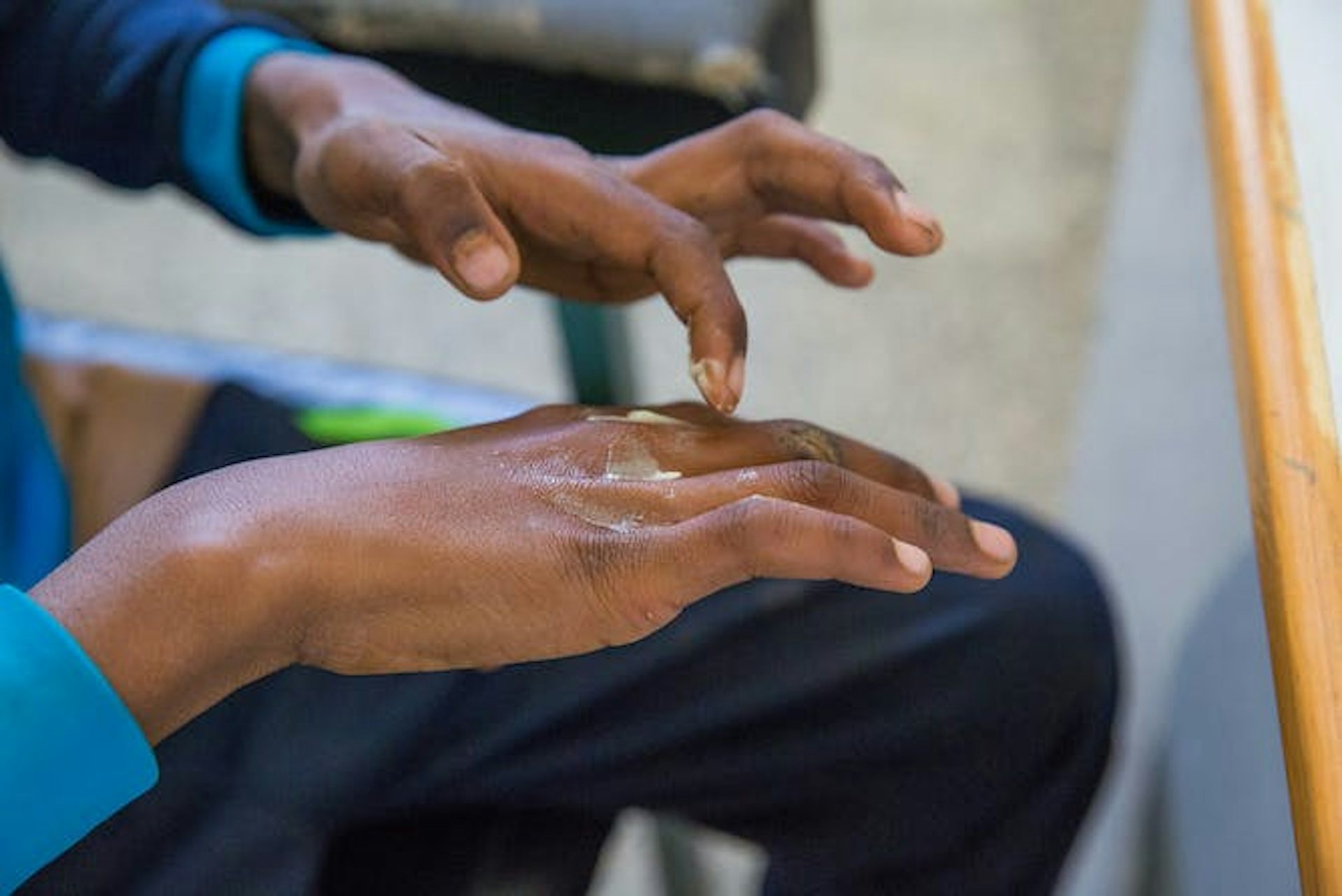 Lèpre, gale et pian : les maladies tropicales négligées de la peau au Togo requièrent une attention particulière