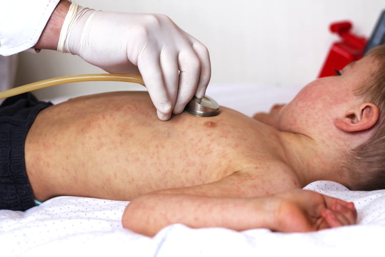 Doctor puts a stethoscope on the chest of a child with measles