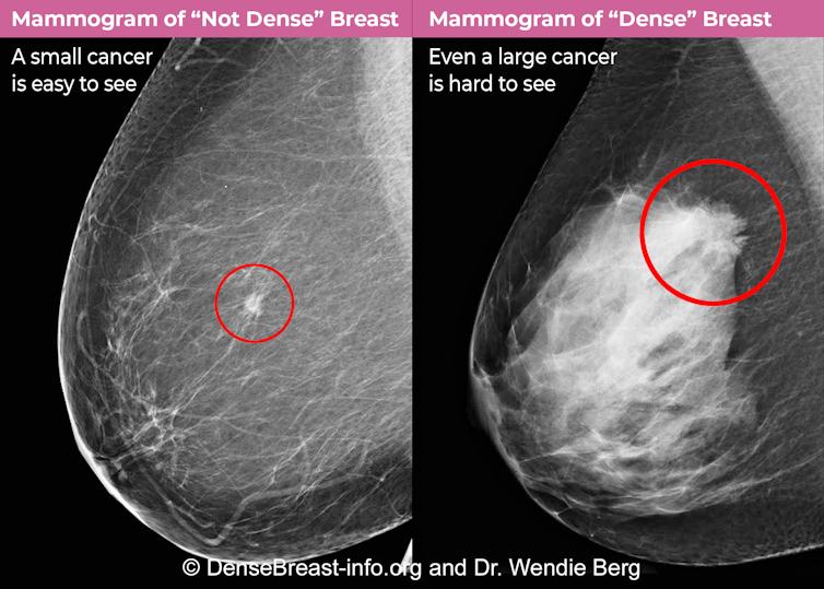Mammography comparison of cancer easily seen in a a fatty ('not dense') breast on the left and hard to see in a'dense' breast on the right.