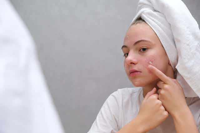 Chica joven aplica crema sobre una zona con acné en su cara.