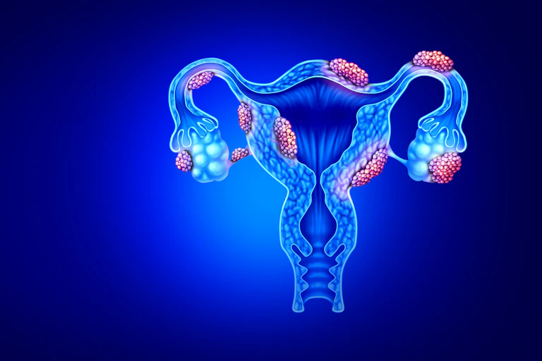 A digital drawing of a uterus with endometriosis.