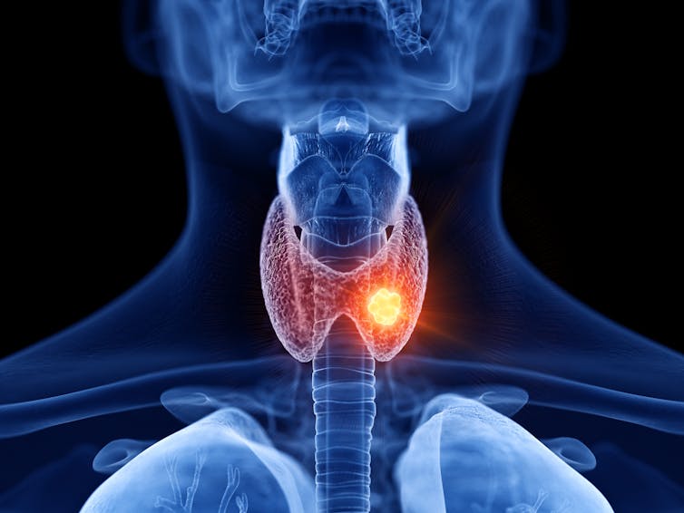 x-ray image of person's neck and thyroid gland