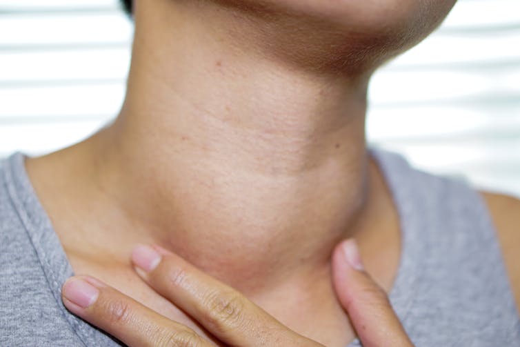 woman's neck with protruding bump at front of throat