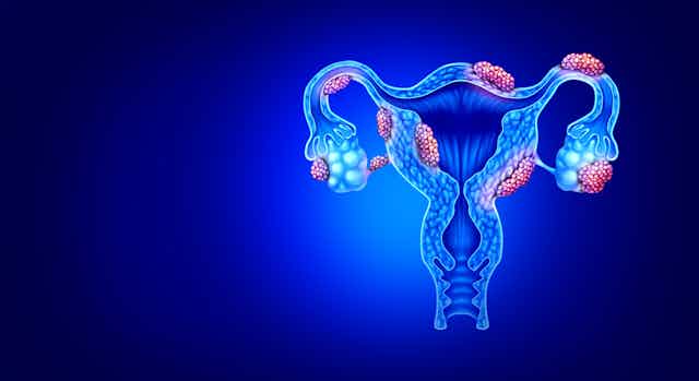 Ilustración de un útero con endometriosis.
