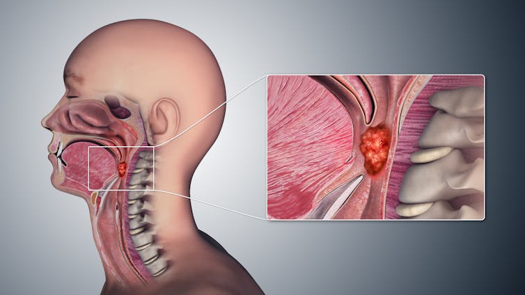 Graphic showing cancer in the oropharynx