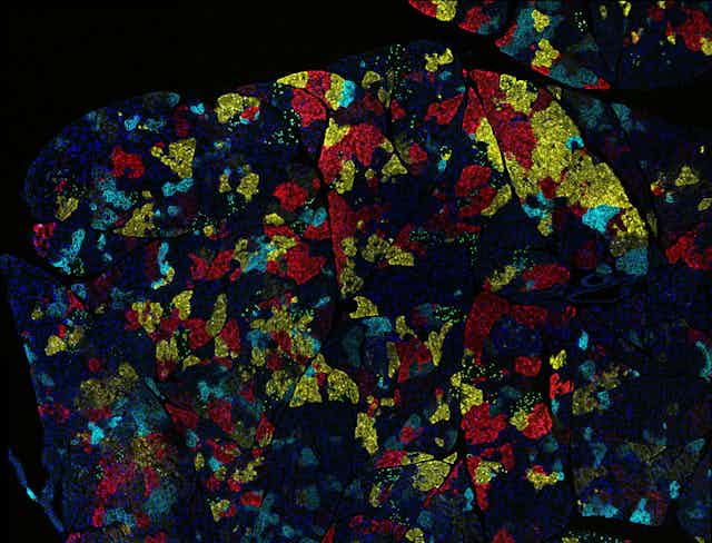 Microscopy image of pancreas tumor with multicolored cell subgroups