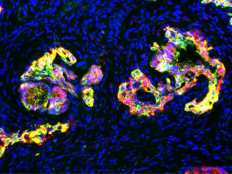 Imagem de microscopia de tecido pancreático pré-canceroso em camundongos