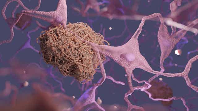 A digital drawing of an amyloid plaque clumped around a neuron.