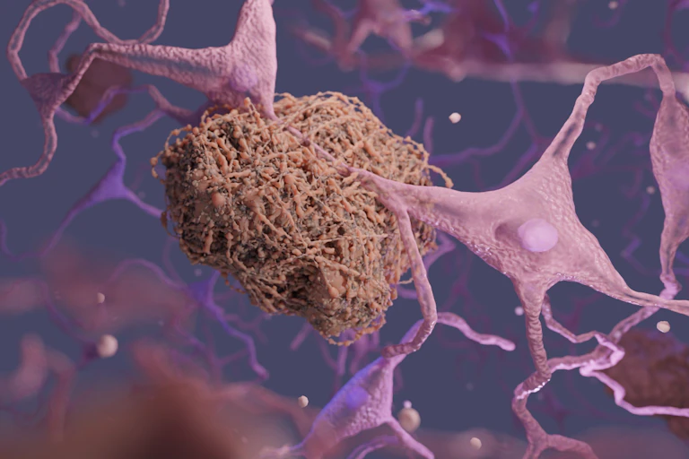 A digital drawing of an amyloid plaque clumped around a neuron.