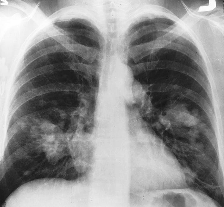 Radiographie de poumons avec taches blanches