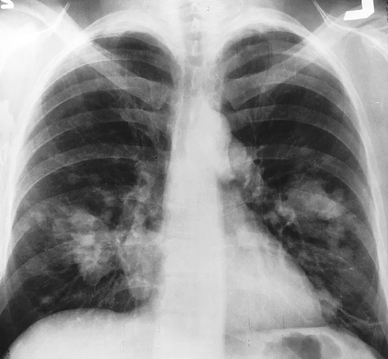 Radiographie de poumons avec taches blanches