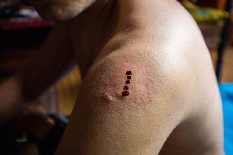 A photo of a person's shoulder with four dark dots on a patch of reddened skin.