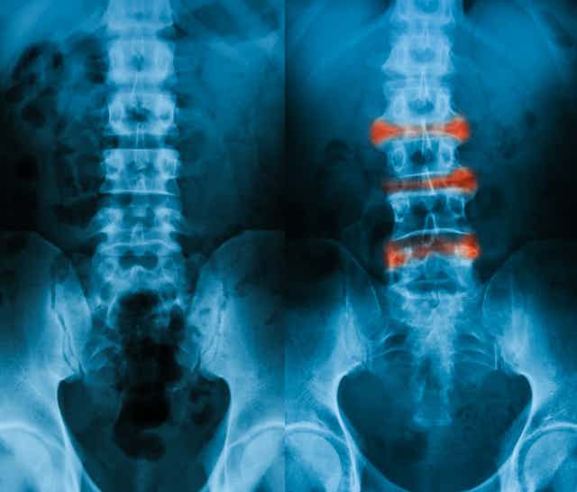 An X-ray image showing two sets of spines. The one of the right is slightly curved with vertebrae marked in red. 