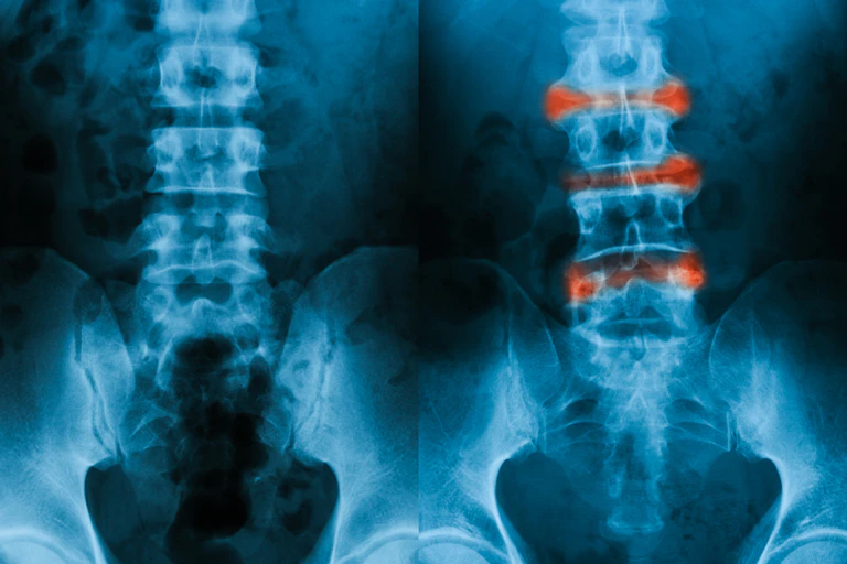 An X-ray image showing two sets of spines. The one of the right is slightly curved with vertebrae marked in red.