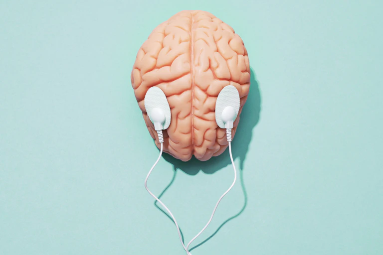 Brain with two electrodes placed on either hemisphere