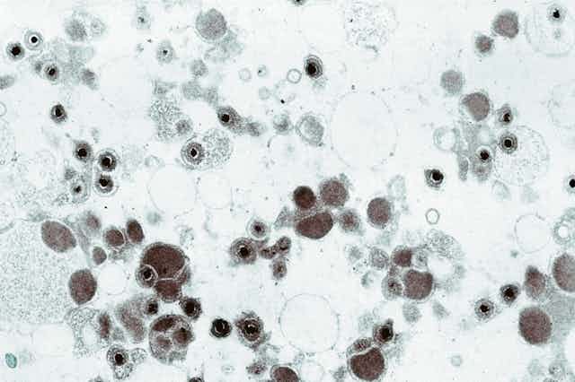 Microscopy image of cytomegalovirus
