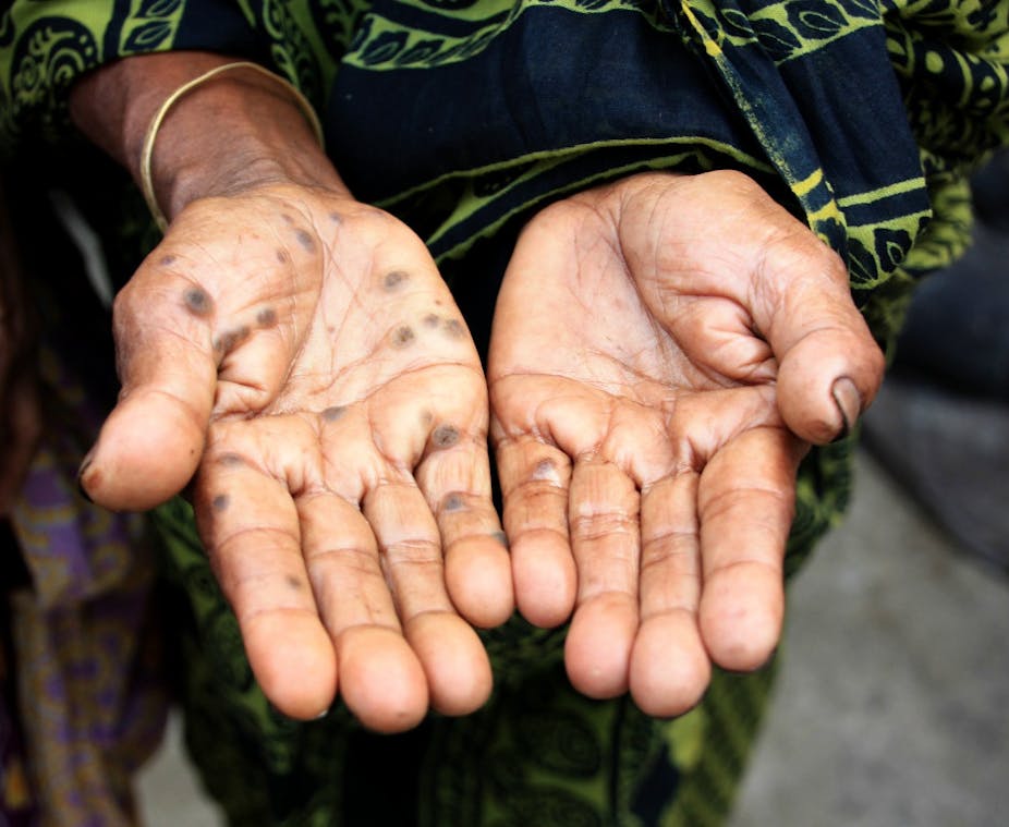 arsenic in water research paper Spotted palms of person with arsenic poisoning