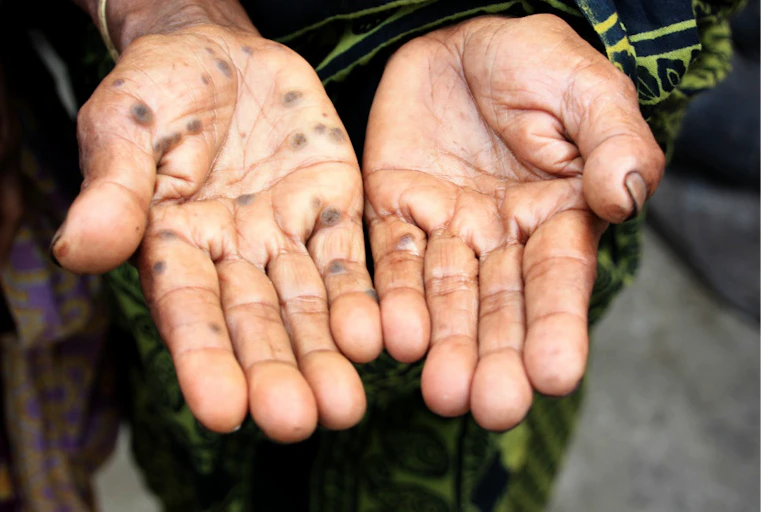 Spotted palms of person with arsenic poisoning